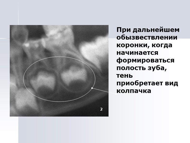 При дальнейшем обызвествлении коронки, когда начинается формироваться полость зуба, тень приобретает вид колпачка
